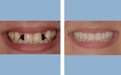 Before and After
